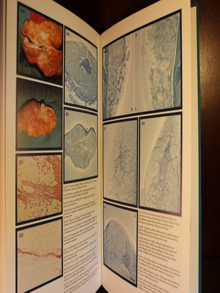 La Xeromammografia Xeromammography Signed